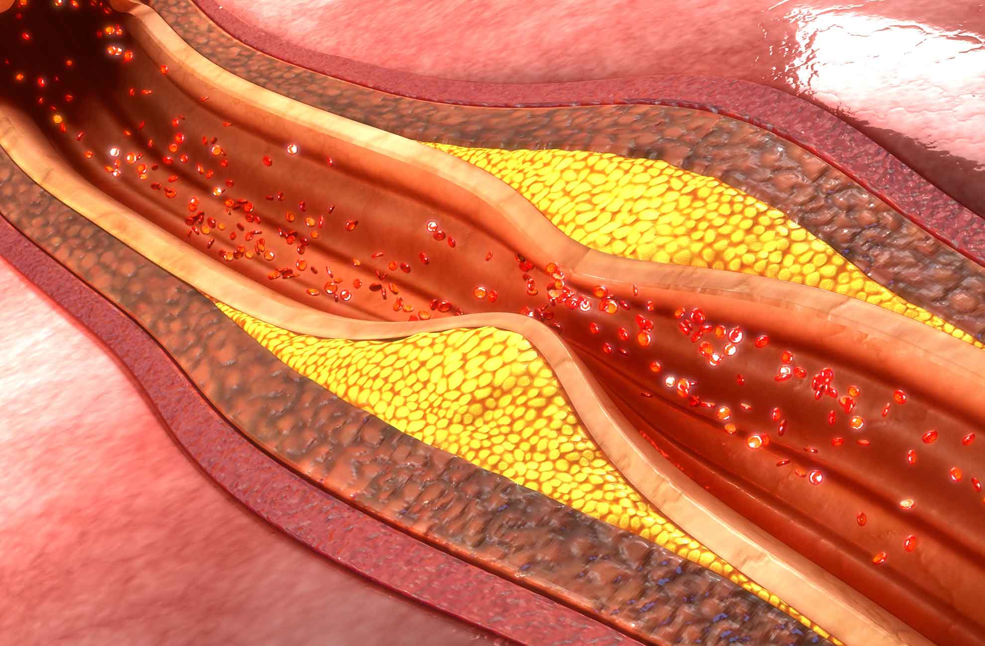 Hipertrigliceridemia e hipercolesterolemia
